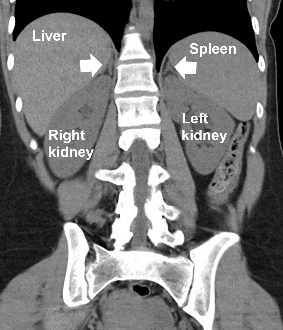 CT scan demonstrating the right and left normal adrenal glands (arrows), sitting on top of the kidneys