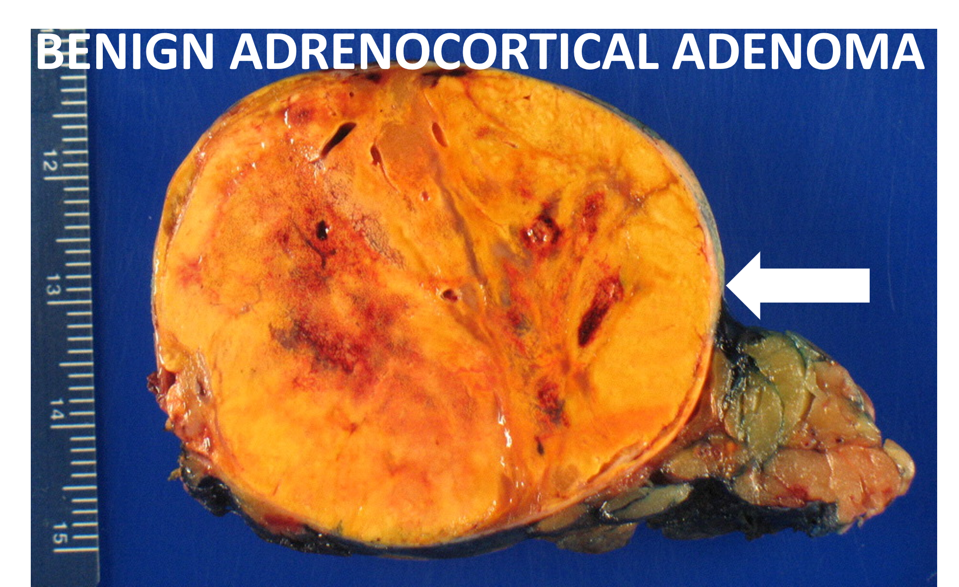 Gross pathology of a typical adrenal adenoma (arrow). It has a typical yellow-orange color. This tumor caused Cushing’s syndrome (too much cortisol).