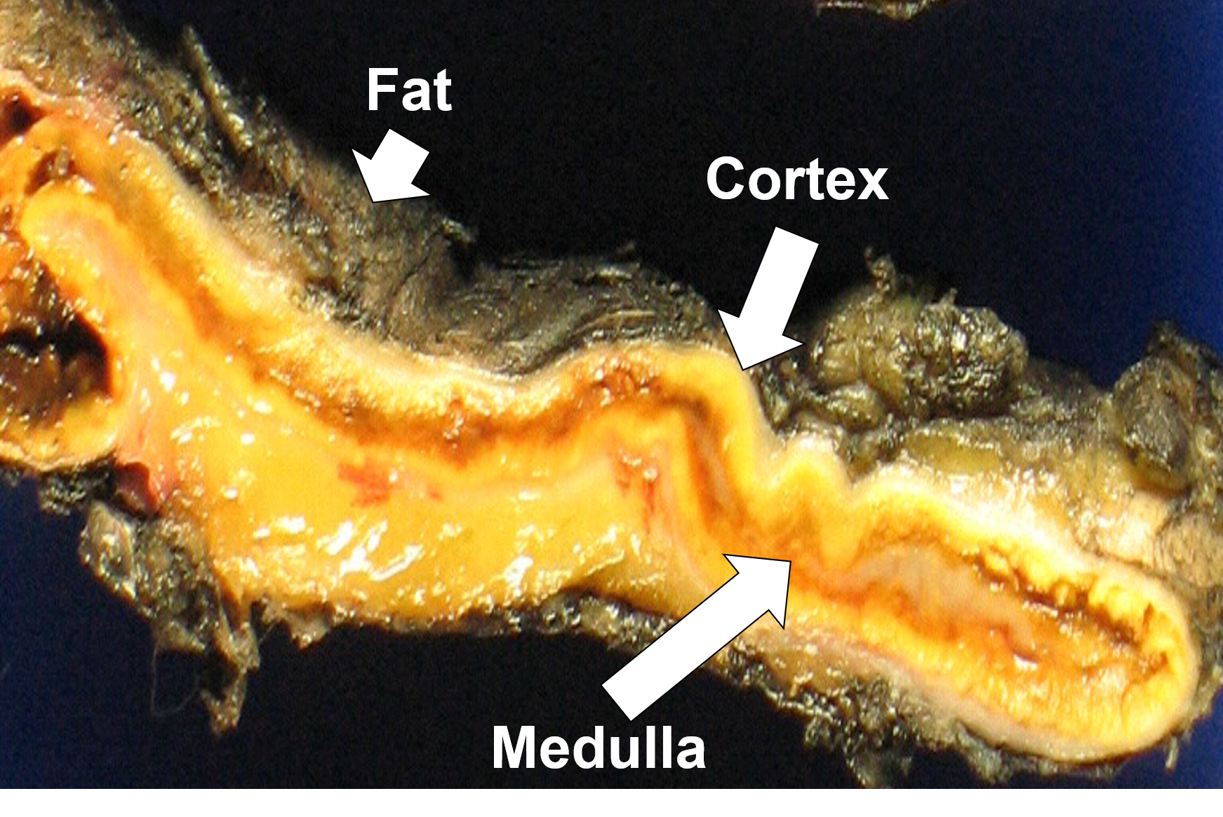 Transection of a portion of normal adrenal tissue displaying the adrenal cortex (yellow), medulla (brownish), and surrounding fat