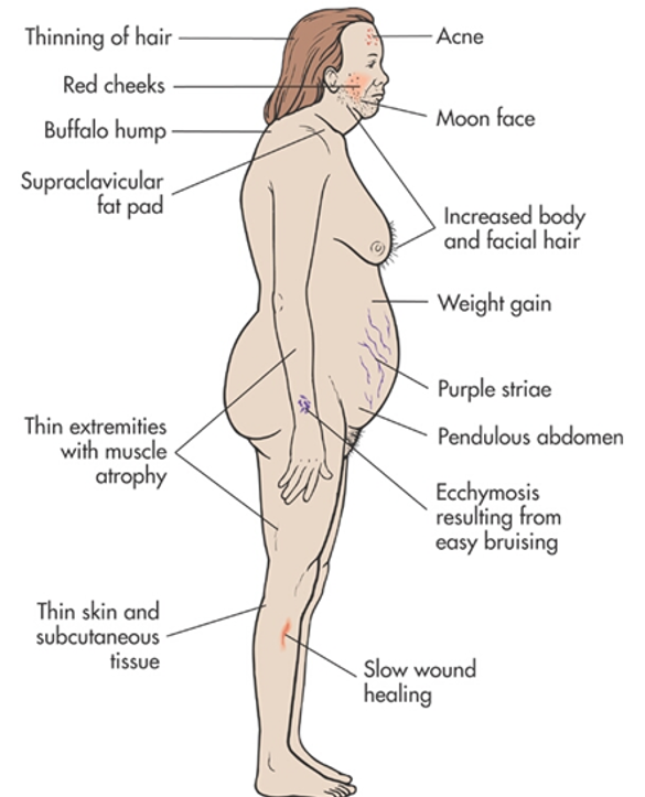 Symptoms of Cushing's Syndrome