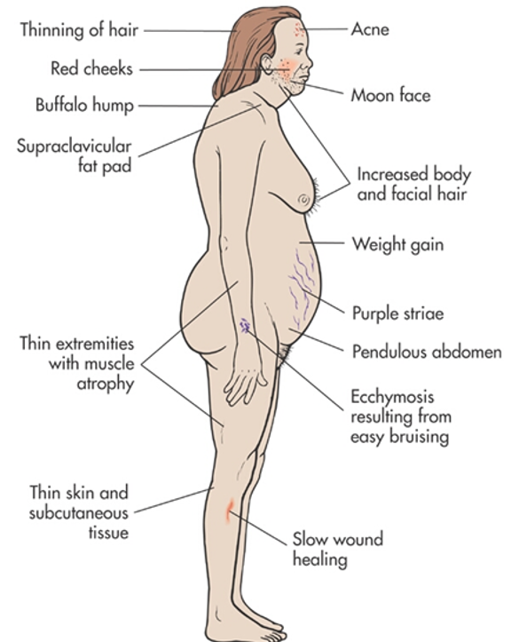 Understanding Dowager's Hump: Causes, Symptoms, And Risk Factors