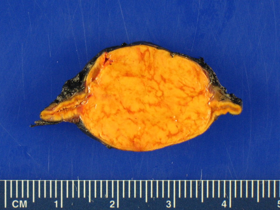 Adrenal tumor producing too much cortisol causing Cushing’s syndrome.