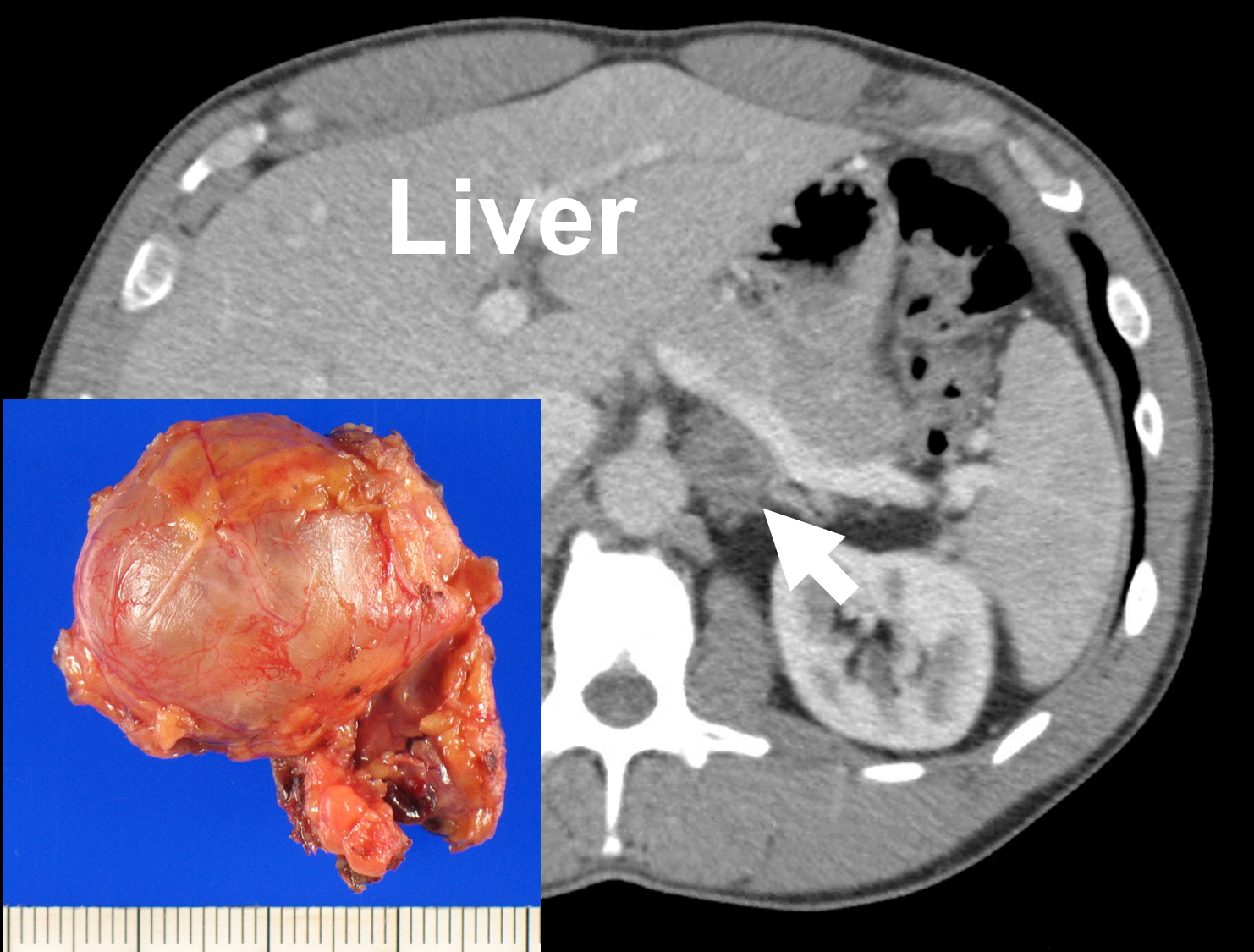 CT scan and gross pathology of a ganglioneuroma (4.3 cm; arrow). This is a rare retroperitoneal tumor, which arise adjacent to the adrenal gland. Similar as an adrenalectomy, it can be removed via a Mini Back Scope approach.
