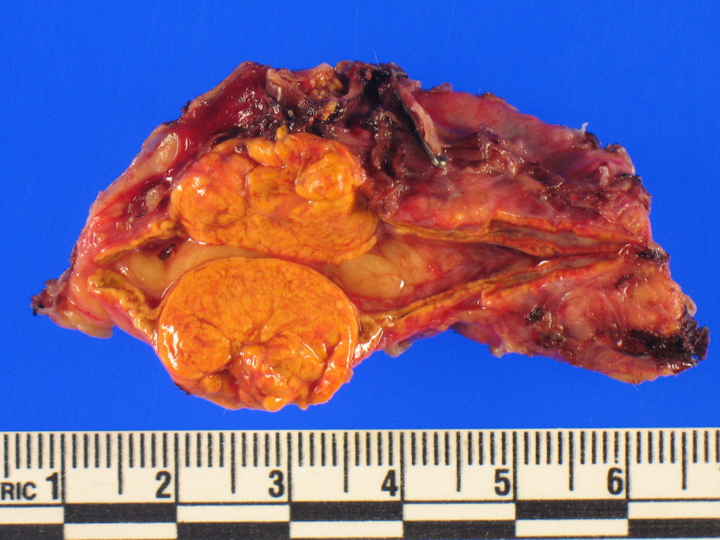 Aldosterone-producing adrenocortical adenoma causing Conn’s syndrome (primary hyperaldosteronism)