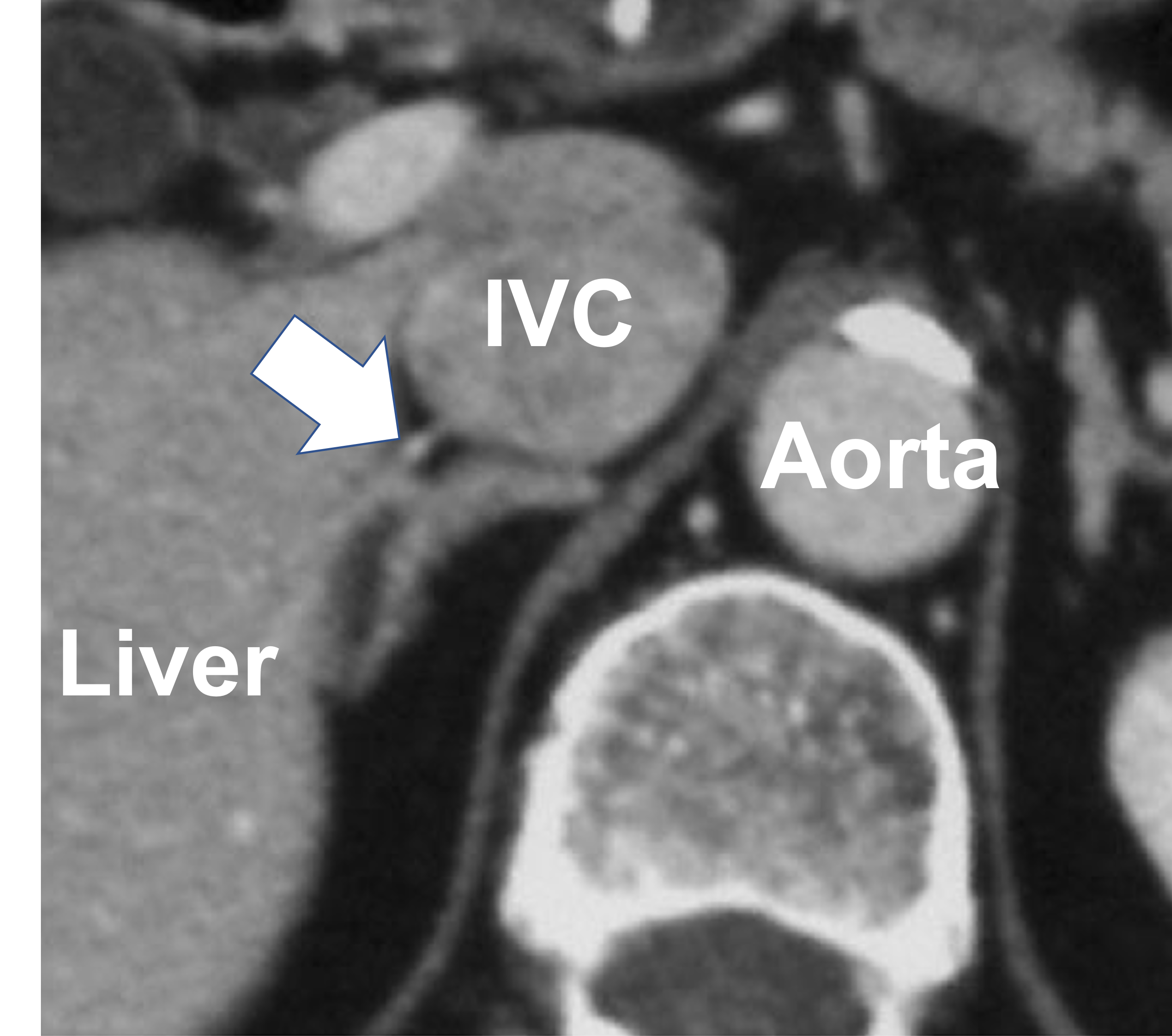 CT scan clearly shows the right adrenal vein (arrow)
