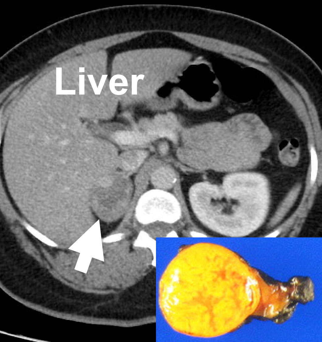 Adrenal protocol, contrast-enhanced CT scan demonstrating a right adrenal adenoma (4.4. cm, arrow), which produced excess cortisol causing Cushing's syndrome. 