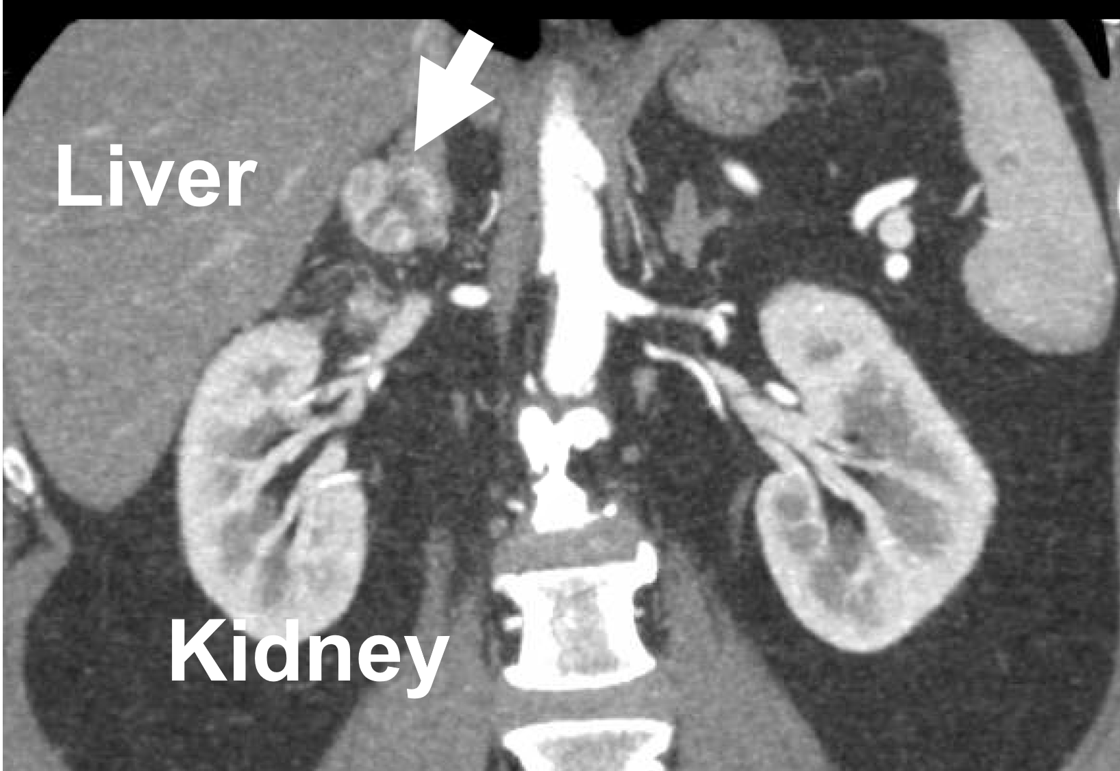 CT scan demonstrating a metastasis from renal cell (kidney) cancer to the right adrenal gland (arrow). Dr. Carling removed this tumor via the Mini Back Scope Adrenalectomy (MBSA) and the patient had no more evidence of kidney cancer.