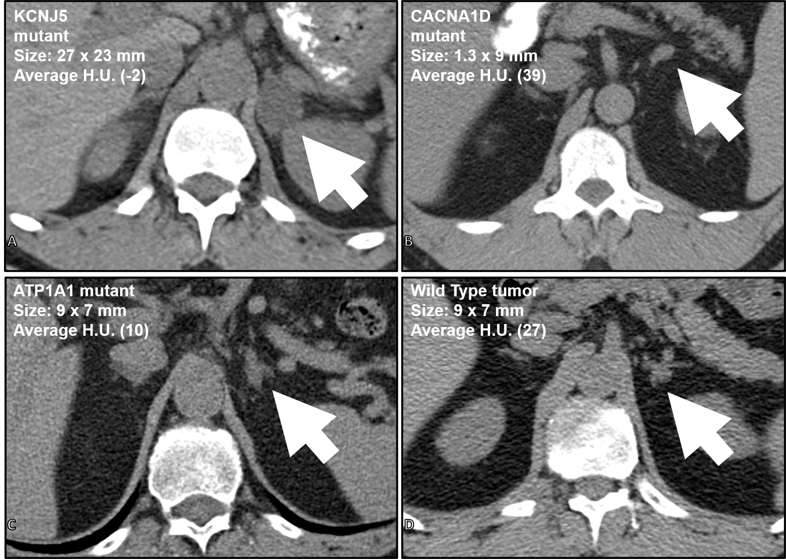 CT scans from 4 different patients all with a left aldosterone-producing tumor (arrow) causing primary hyperaldosteronism. 