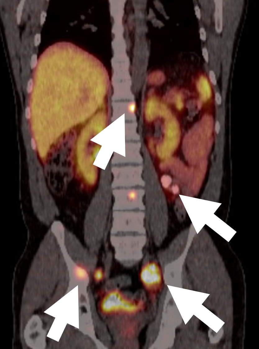 A 68 DOTATATE PET/CT scan for malignant pheochromocytoma demonstrating multiple metastatic lesions in bone and lymph nodes (arrows).