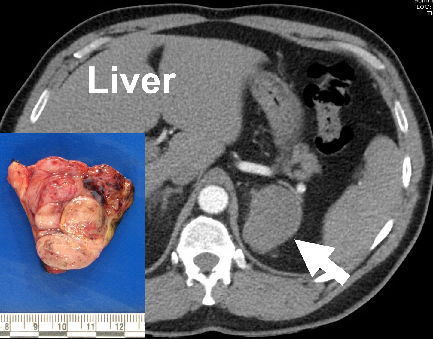 X Rays Ct Scans Mri And Other Tests For Adrenal Glands