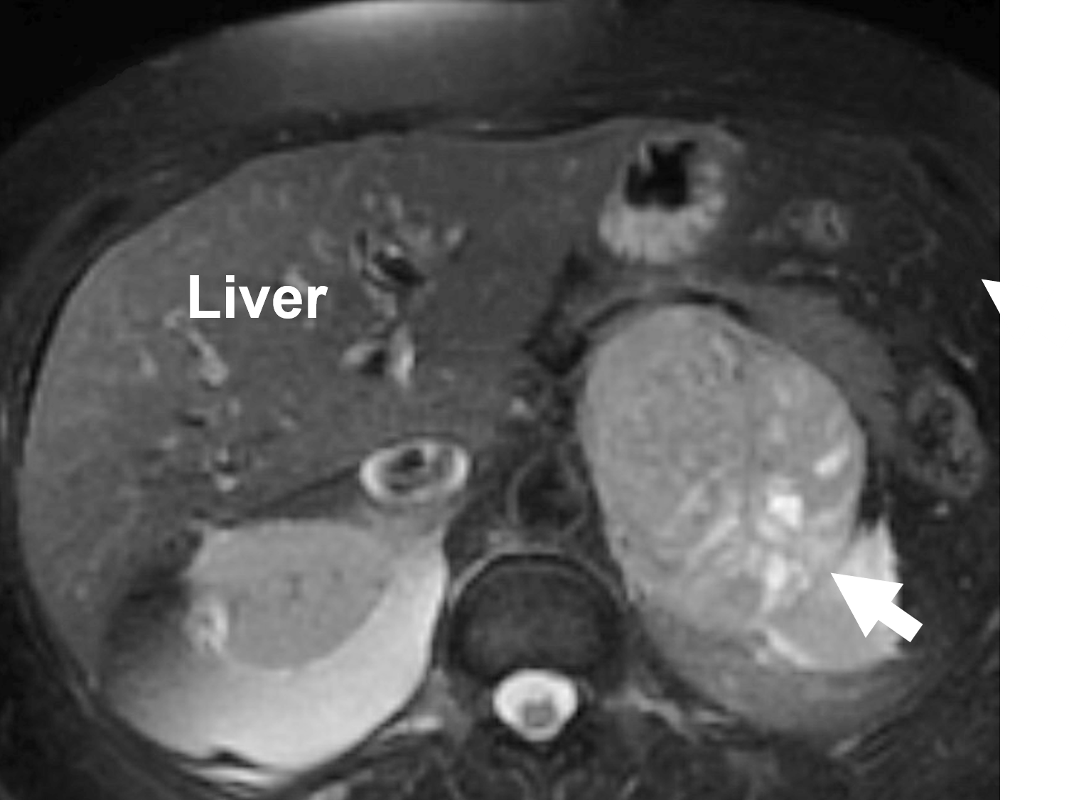 kidney adrenal gland tumor kidney adrenal gland tumor