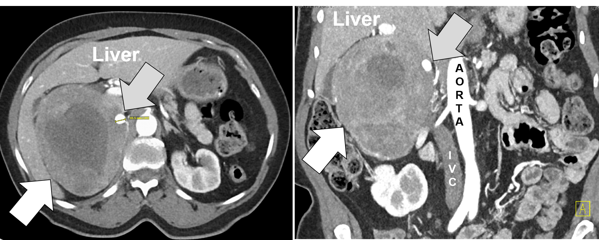 A huge right pheochromocytoma removed by Dr Carling via Laparoscopic Hand-Port Assisted Trans-Abdominal Adrenalectomy.