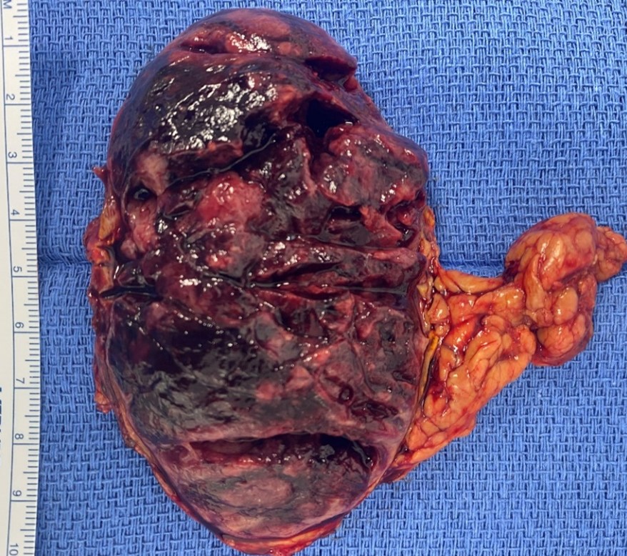 Typical right pheochromocytoma after it was removed by the Mini Back Scope Adrenalectomy (MBSA) surgery by Dr. Carling.