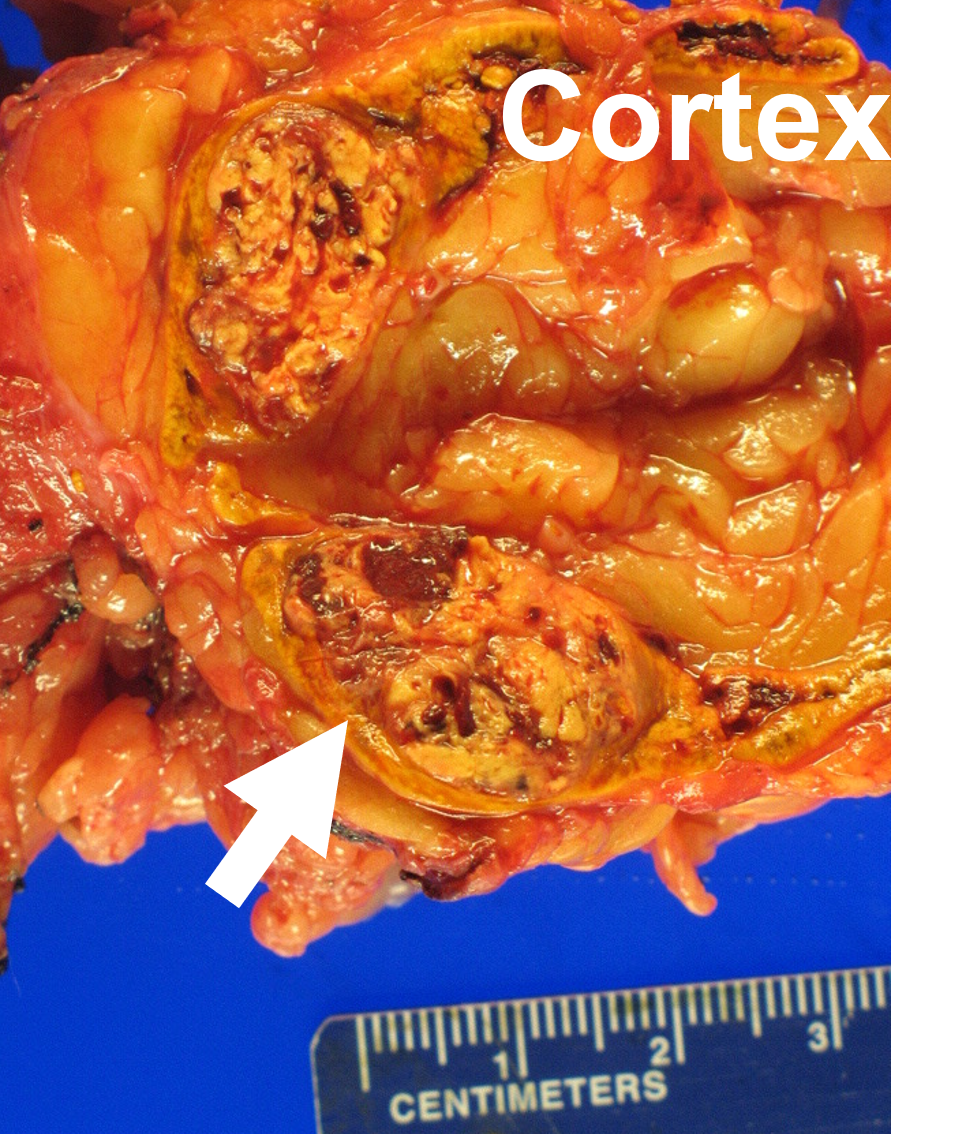 Adrenal metastasis from stage 4 kidney cancer (Renal Cell Carcinoma) arising in the normal adrenal cortex.
