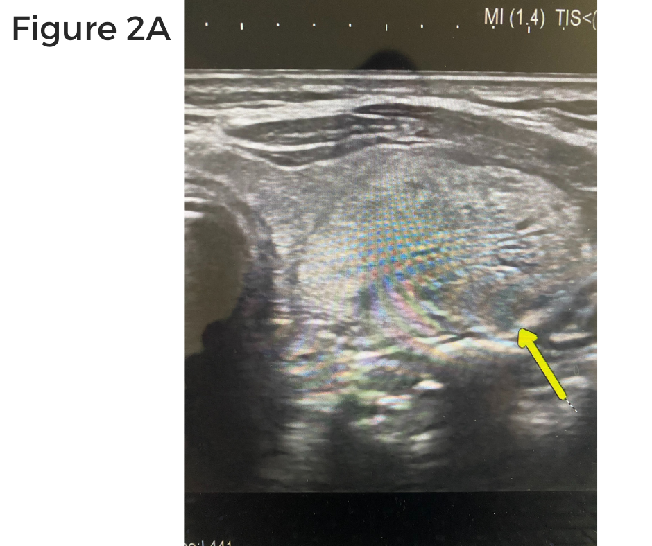 Interesting case of the week: What could be better? Getting two endocrine tumors fixed in one visit! Fig 2