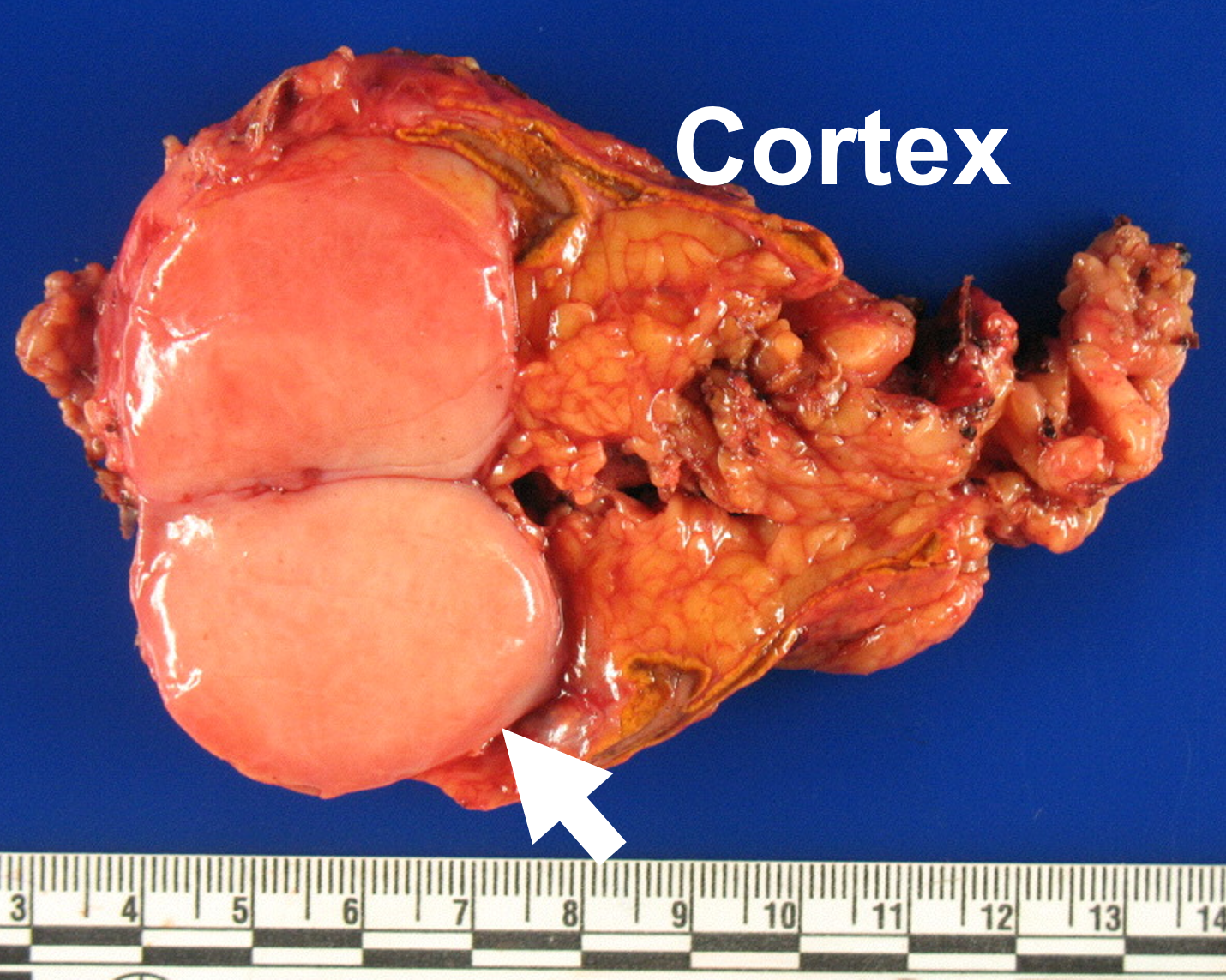 Adrenal metastasis from stage 4 lung cancer (Non-small cell lung cancer; NSCLC; arrow) arising in the normal adrenal cortex.