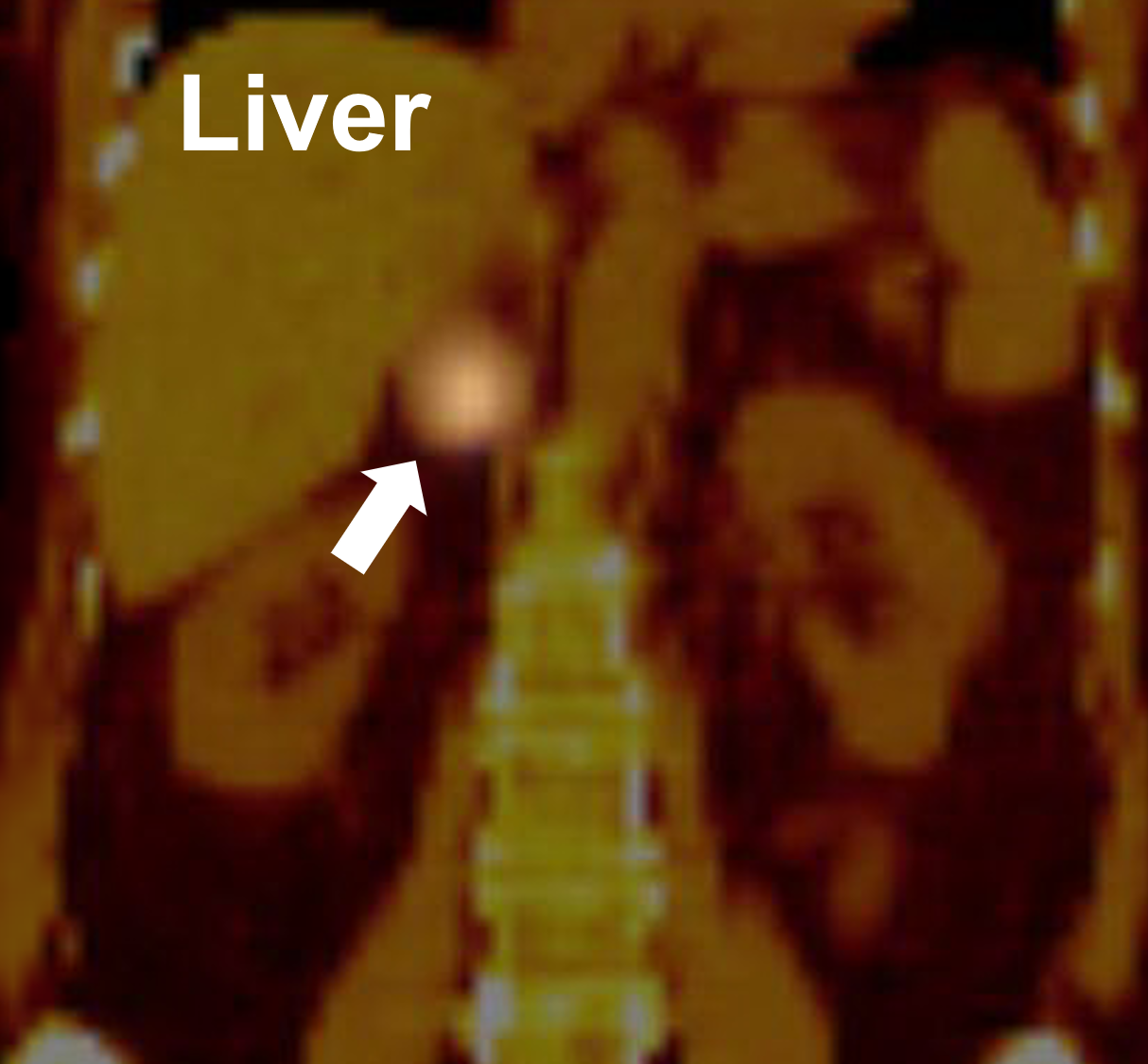 An MIBG scan demonstrating positive uptake in the right adrenal gland (arrow) proving to be a pheochromocytoma.