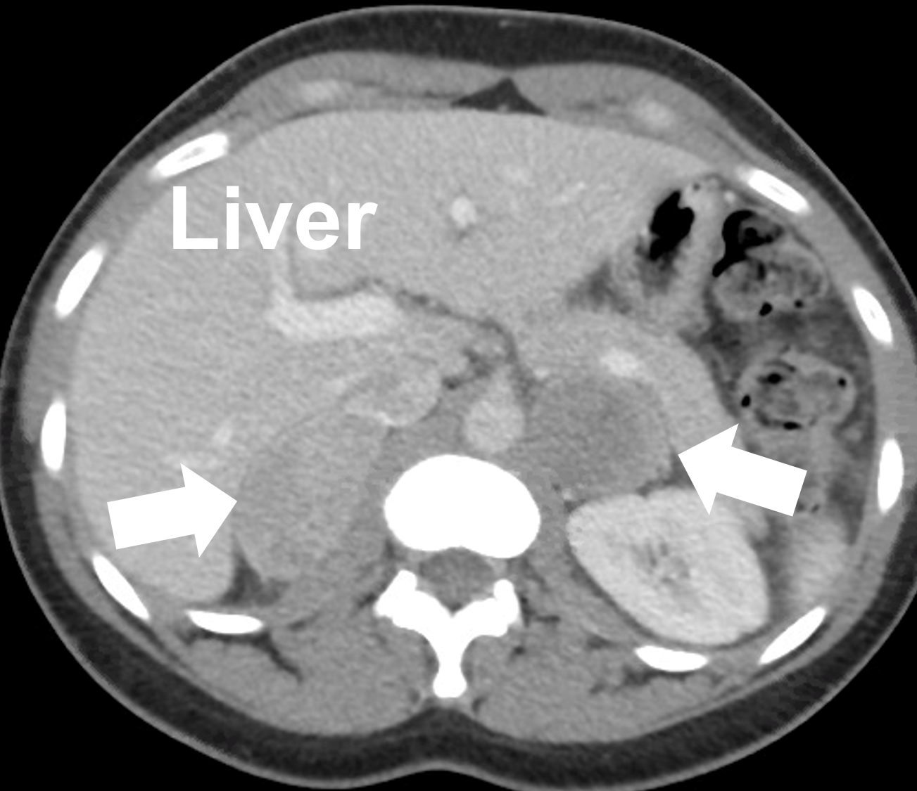Bilateral (both left and right) pheochromocytomas seen on a CT scan (arrows) in a young patient with inherited pheochromocytomas due to multiple endocrine neoplasia type 2A.