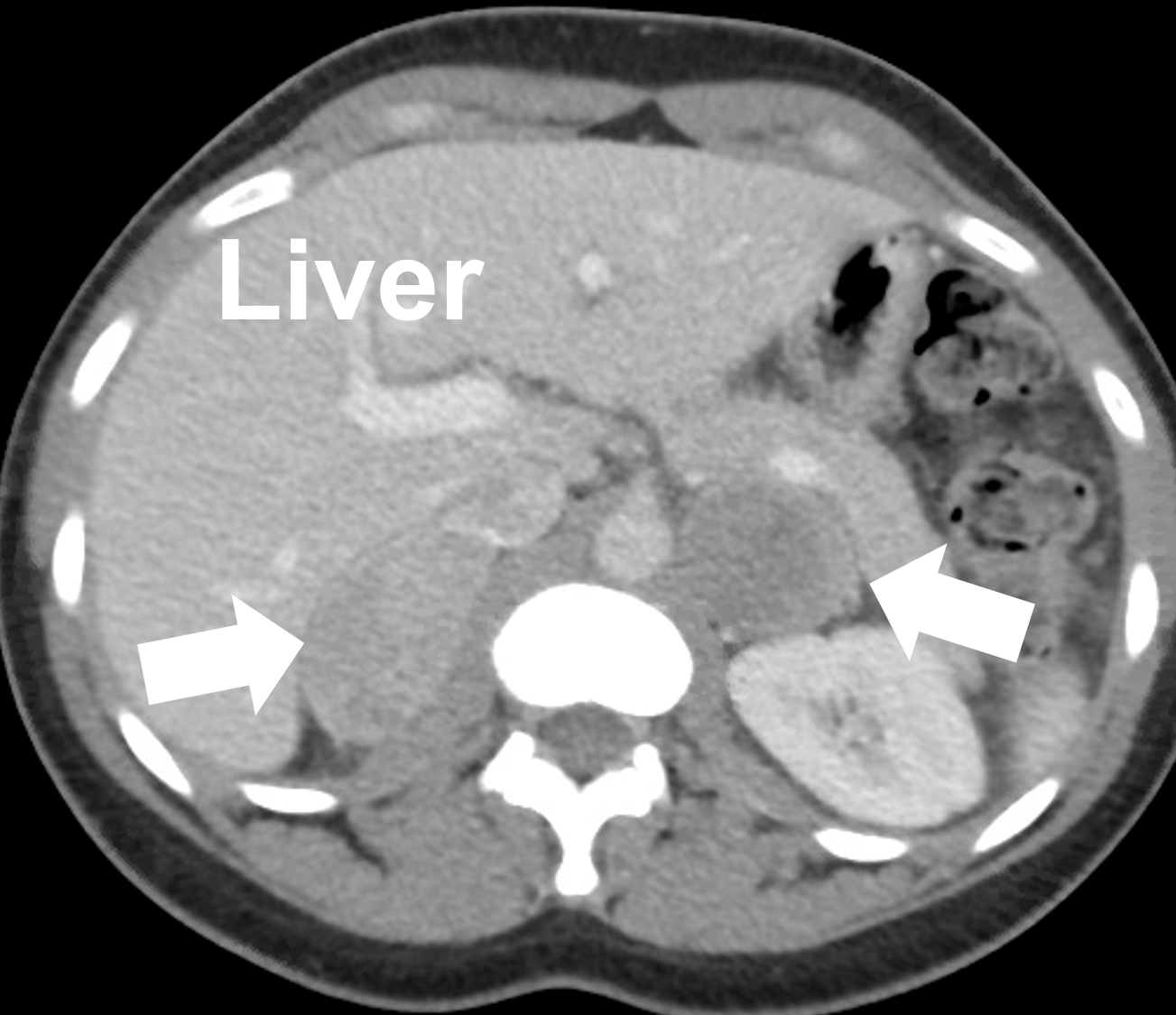 View of Surgical and Pharmacological Management of Functioning  Pheochromocytoma and Paraganglioma