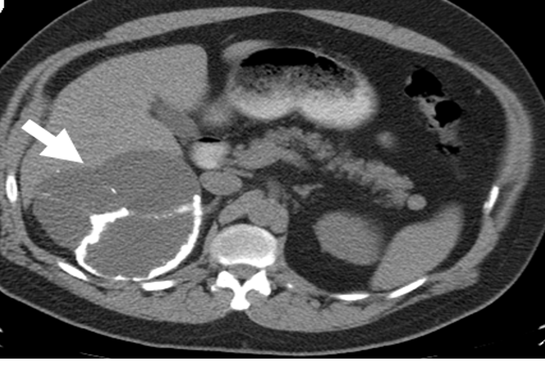 A huge cystic lymphangioma arising from the right adrenal gland. This is a rare tumor but has a characteristic appearance on a CT scan