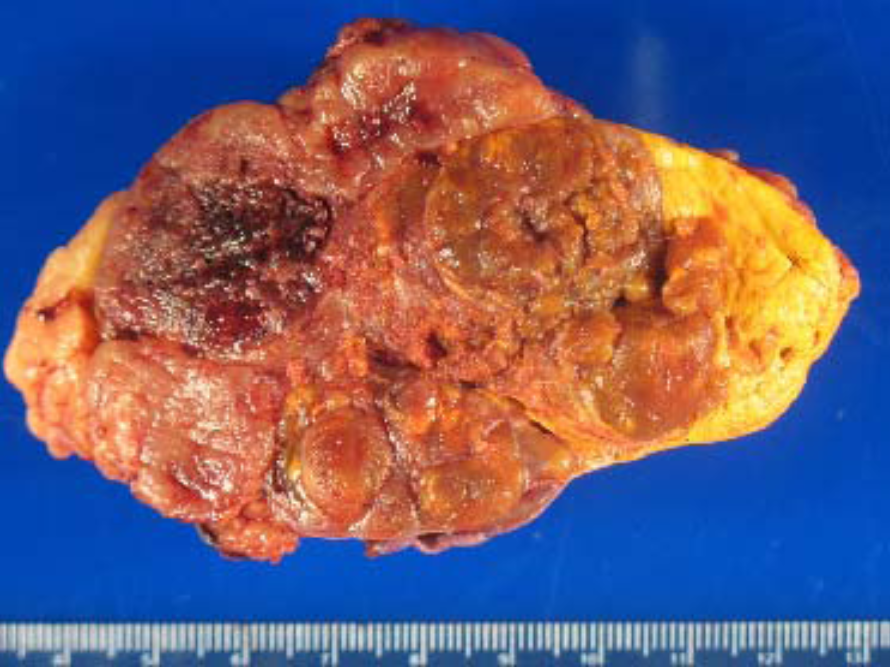 A typical 10 cm adrenal cancer demonstrating irregular borders, invasion, and areas of necrosis (dead cells) and hemorrhage (bleeding).