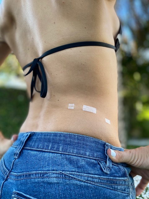 Small Steri-strips (Band-Aids) after Right Mini Back Scope Adrenalectomy; MBSA