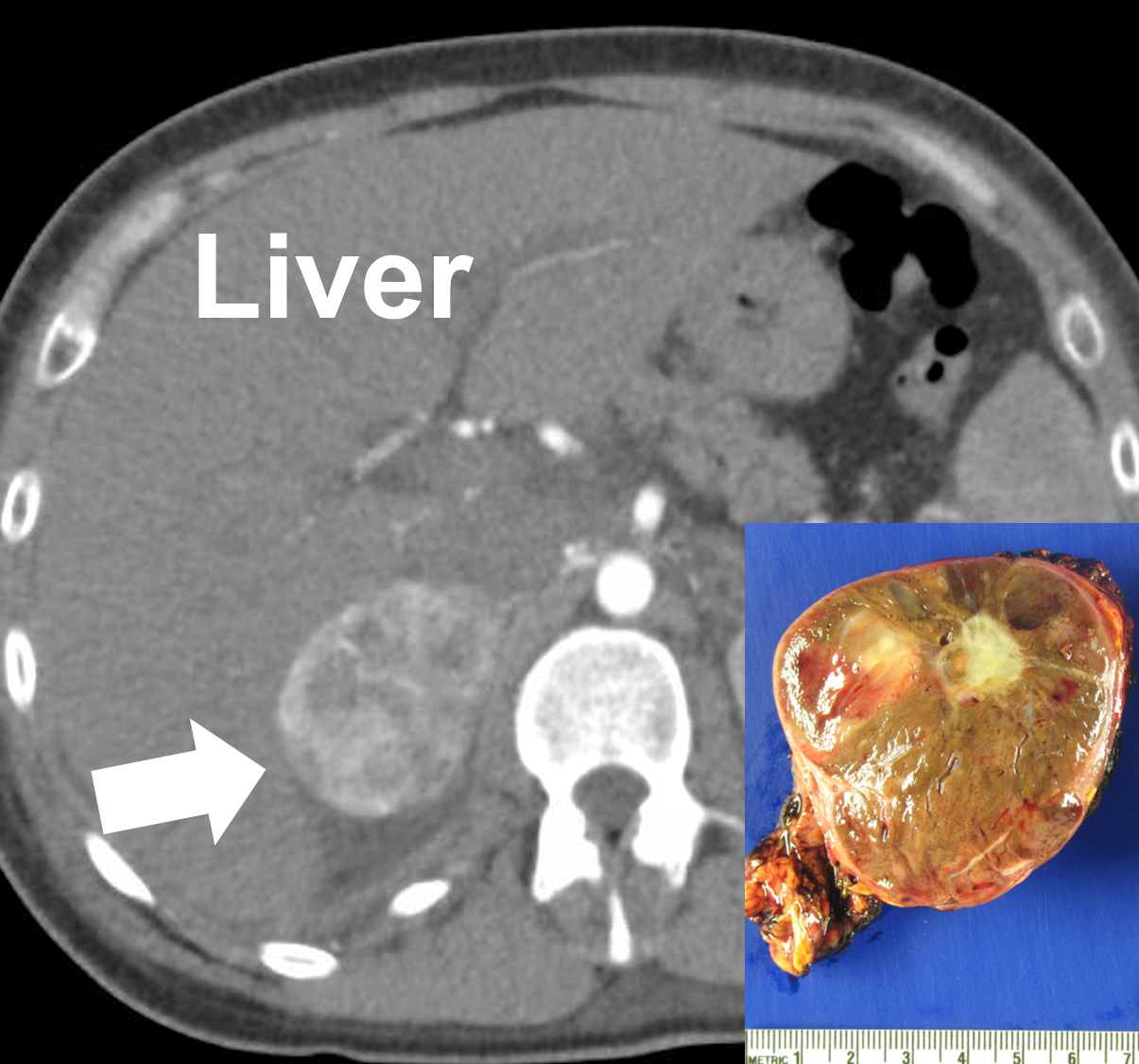A right 6 cm pheochromocytoma seen on a CT scan (arrow) and after removal. Pheochromocytomas are vascular and may appear variable with solid, cystic, calcified, and necrotic components.