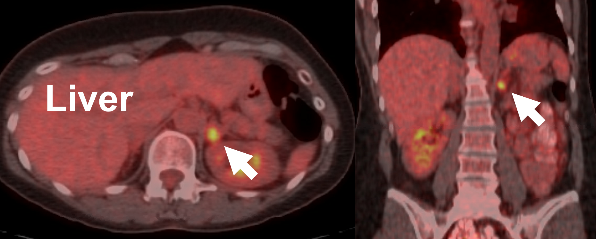 FDG-PET scan of demonstrating an adrenal metastasis to the left adrenal gland from a poorly differentiated lung cancer resected by Dr. Carling using the Mini Back Scope Adrenalectomy (MBSA). The patient is alive and well 6 years after the operation.