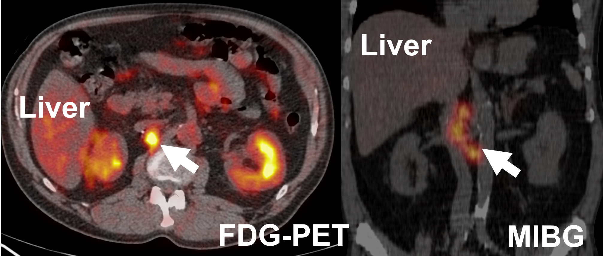 FDG-PET and MIBG scans demonstrating recurrent pheochromocytoma in the right adrenal bed (arrow) due to tumor spillage at the first operation. 