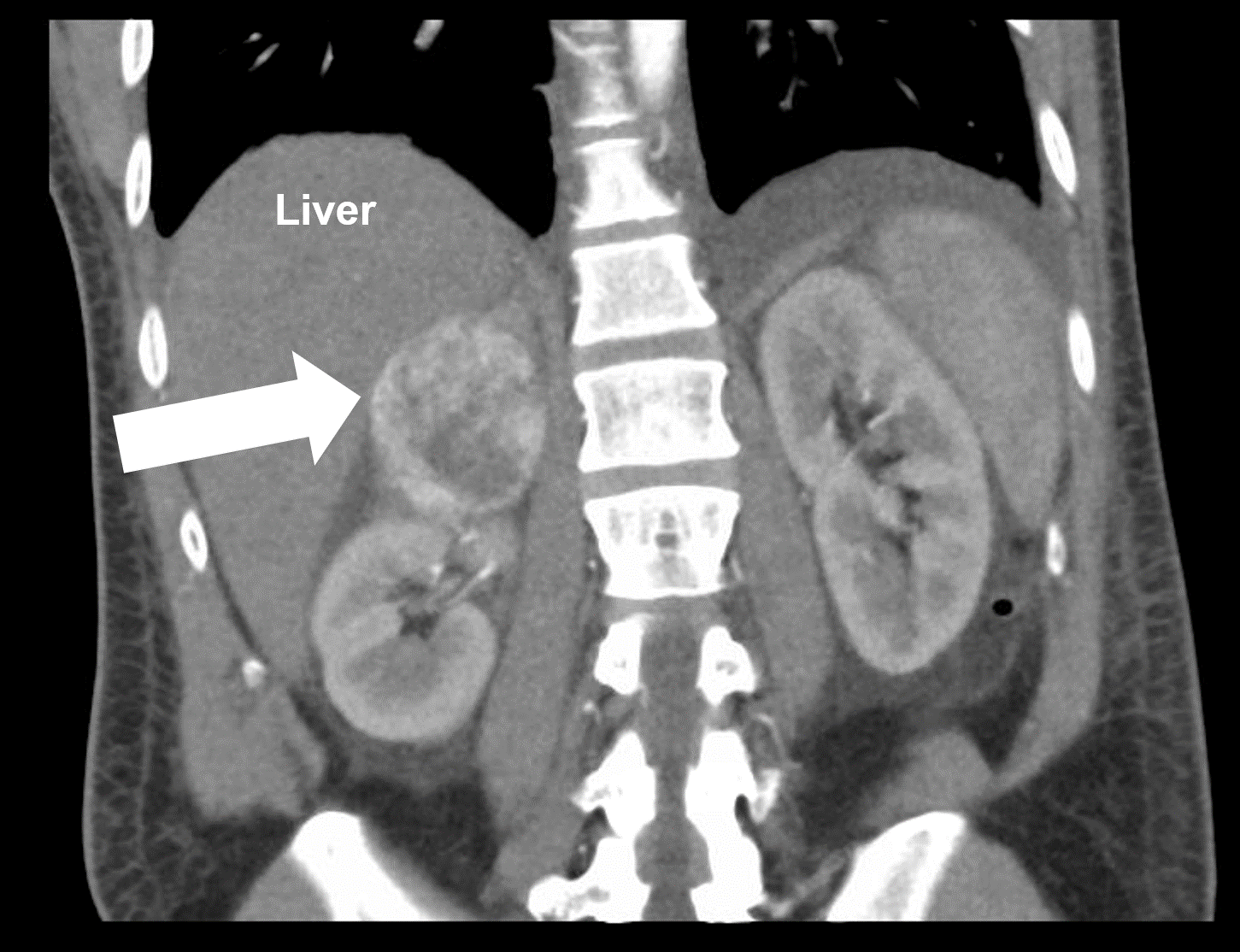 A right adrenal tumor (arrow) seen on a CT scan. This proved to be a pheochromocytoma (too much adrenaline hormone production)