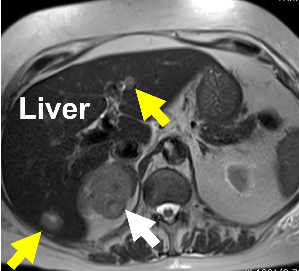 A larger tumor is more likely to be a cancer. This MRI displays an 8 cm right adrenal cancer (white arrow). This patient already had spread (metastasis) to the liver (yellow arrow) at the time of diagnosis.