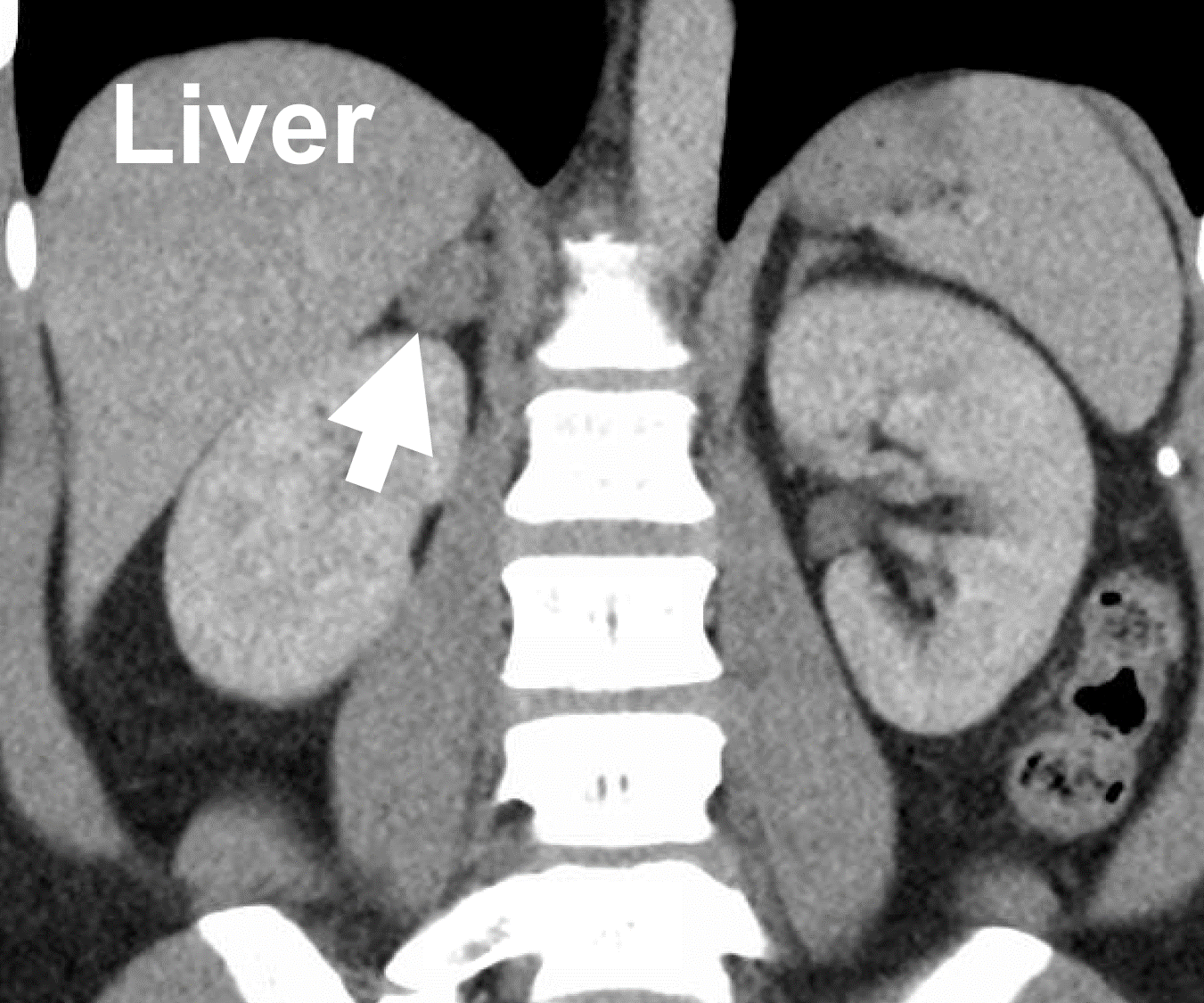 A typical CT scan demonstrating a right aldosterone-producing adrenal adenoma (arrow) causing Conn’ syndrome.