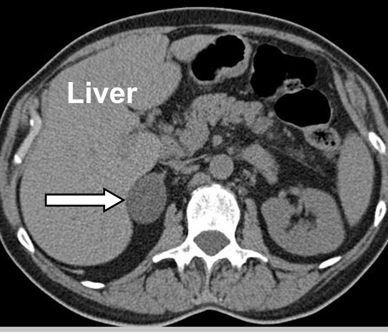 A non-contrast CT scan displaying a right adrenal incidentaloma. All incidentally identified adrenal tumors need to be worked up to ensure they do not overproduce hormones or are cancerous.