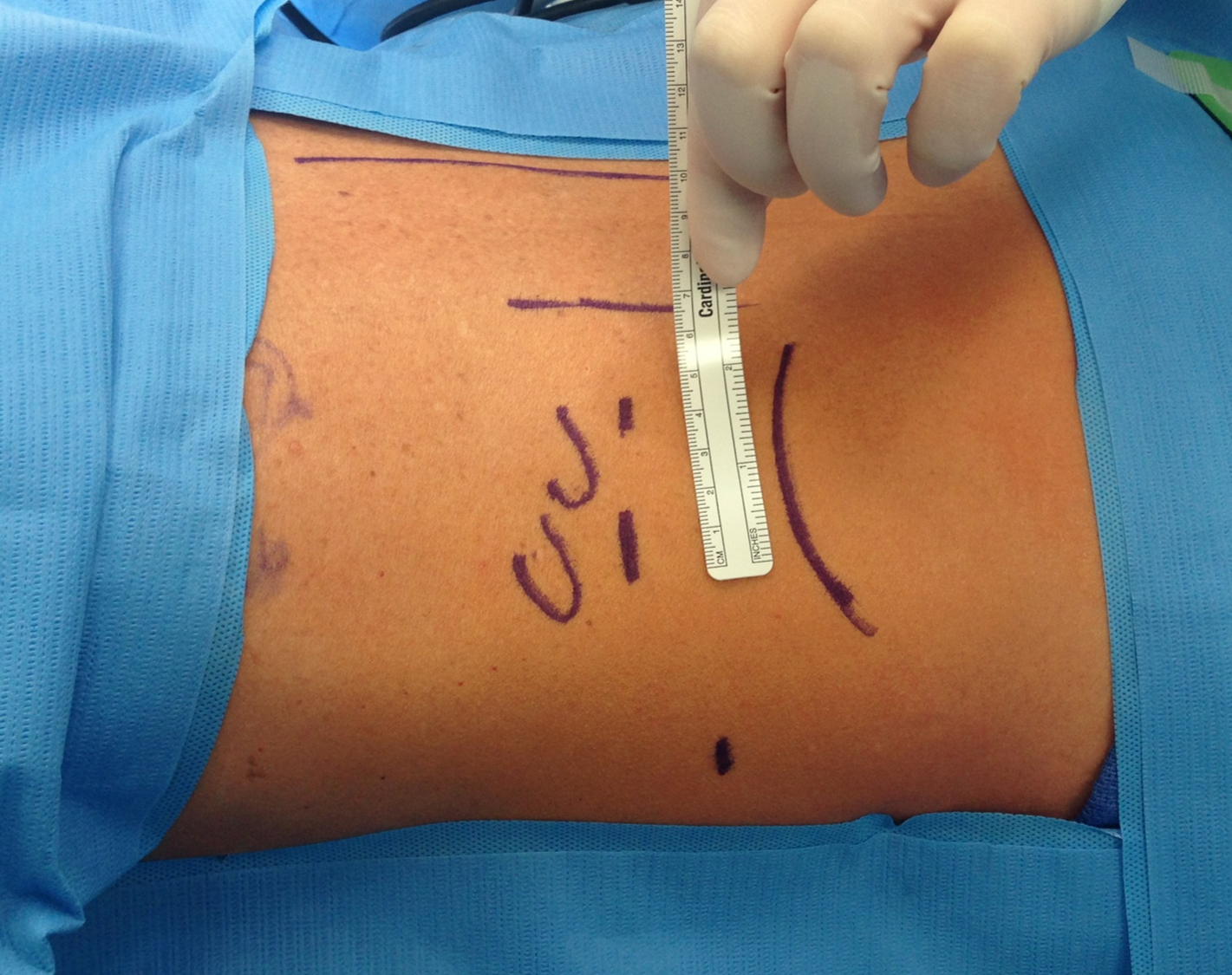 The very small incisions below the 11th and 12th rib of the back used for successful Mini Back Scope Adrenalectomy (MBSA)