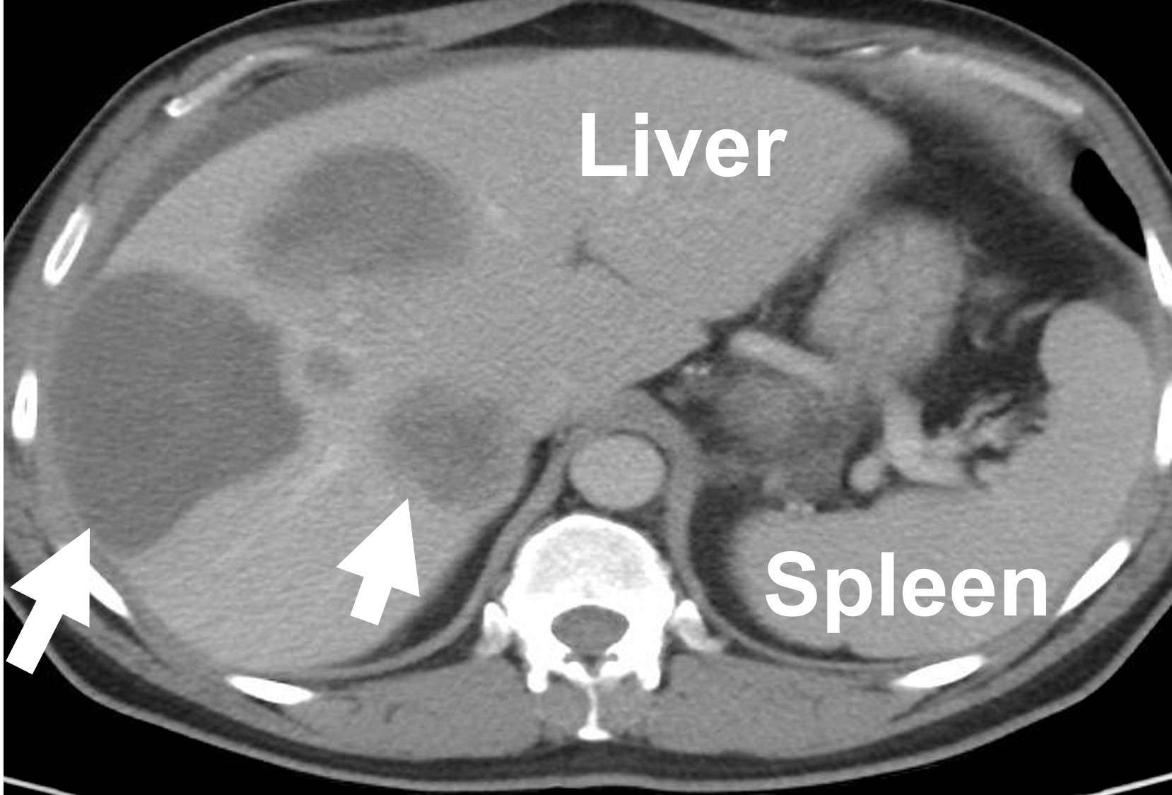 CT showing liver metastasis (arrows) from an adrenal cancer arising from the right left gland. This tumor overproduced estrogen causing feminization (acquisition of female traits in a male).