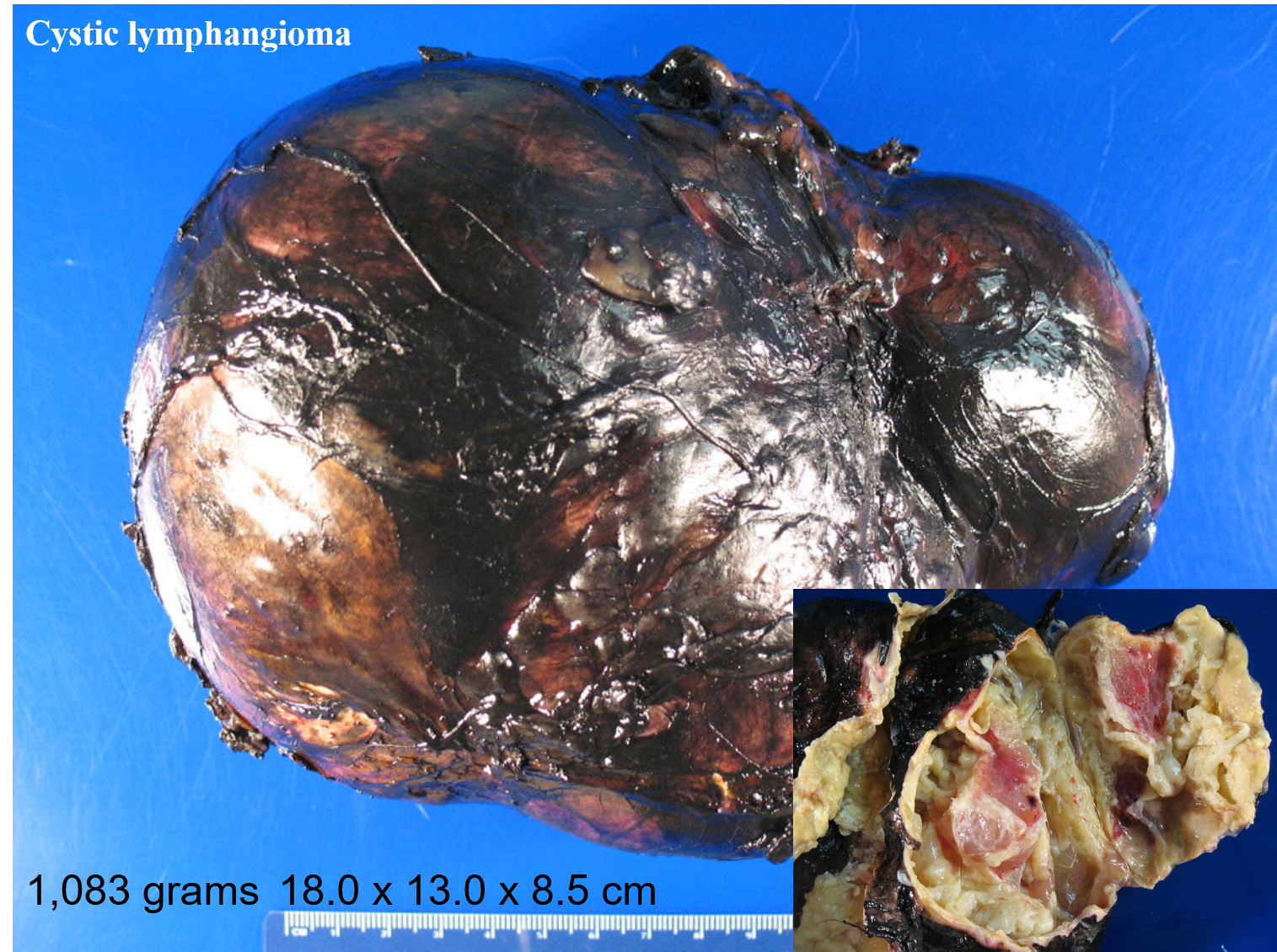 A huge cystic lymphangioma arising from the right adrenal gland. Dr. Carling removed it and it weighed close to 2.5 lbs.