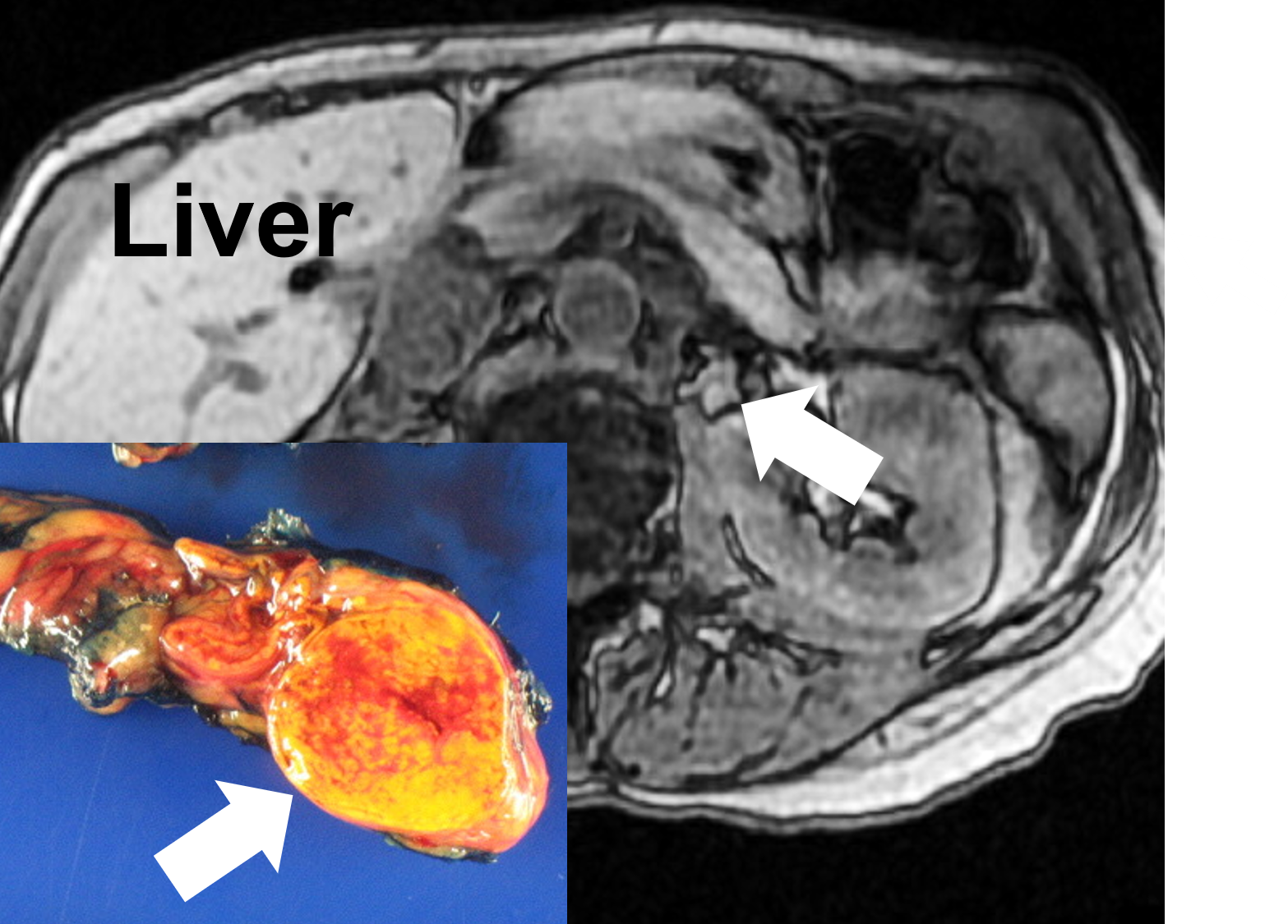 An MRI demonstrating the left aldosteronoma (arrow aldosterone-producing adenoma; APA) causing Conn’s syndrome, and after removal via Mini Back Scope Adrenalectomy (MBSA)