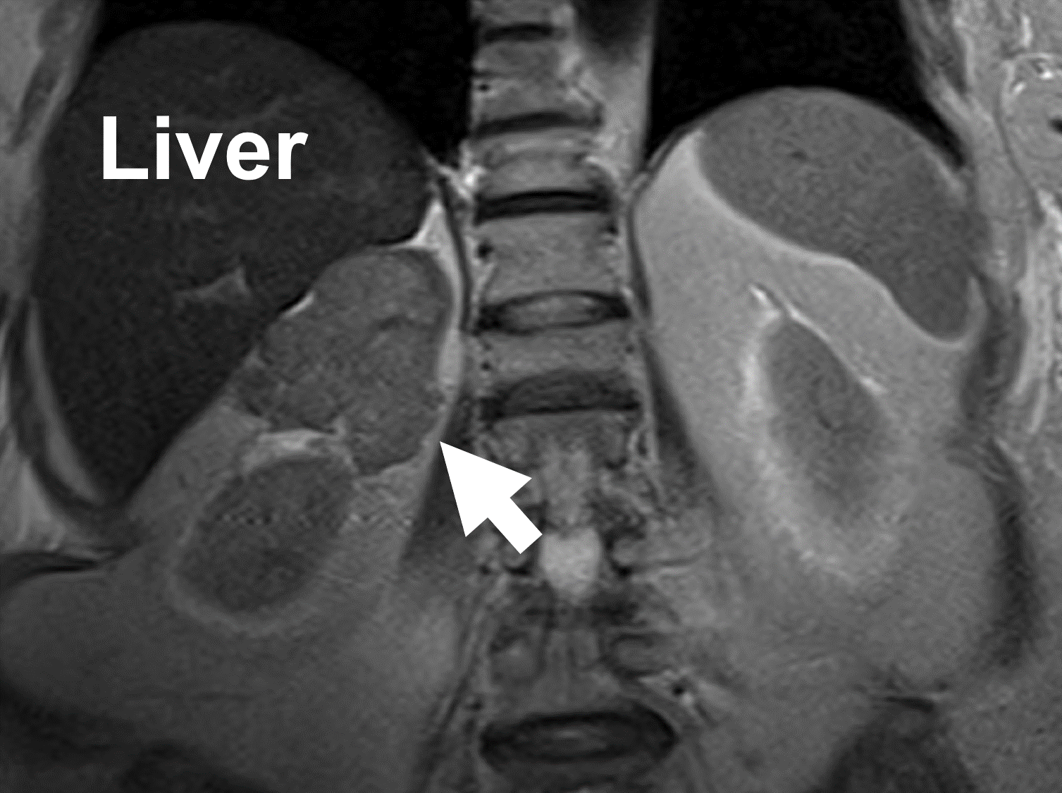 MRI showing an adrenal cancer (arrow) arising from the right adrenal gland. Note the heterogeneity and irregular borders.
