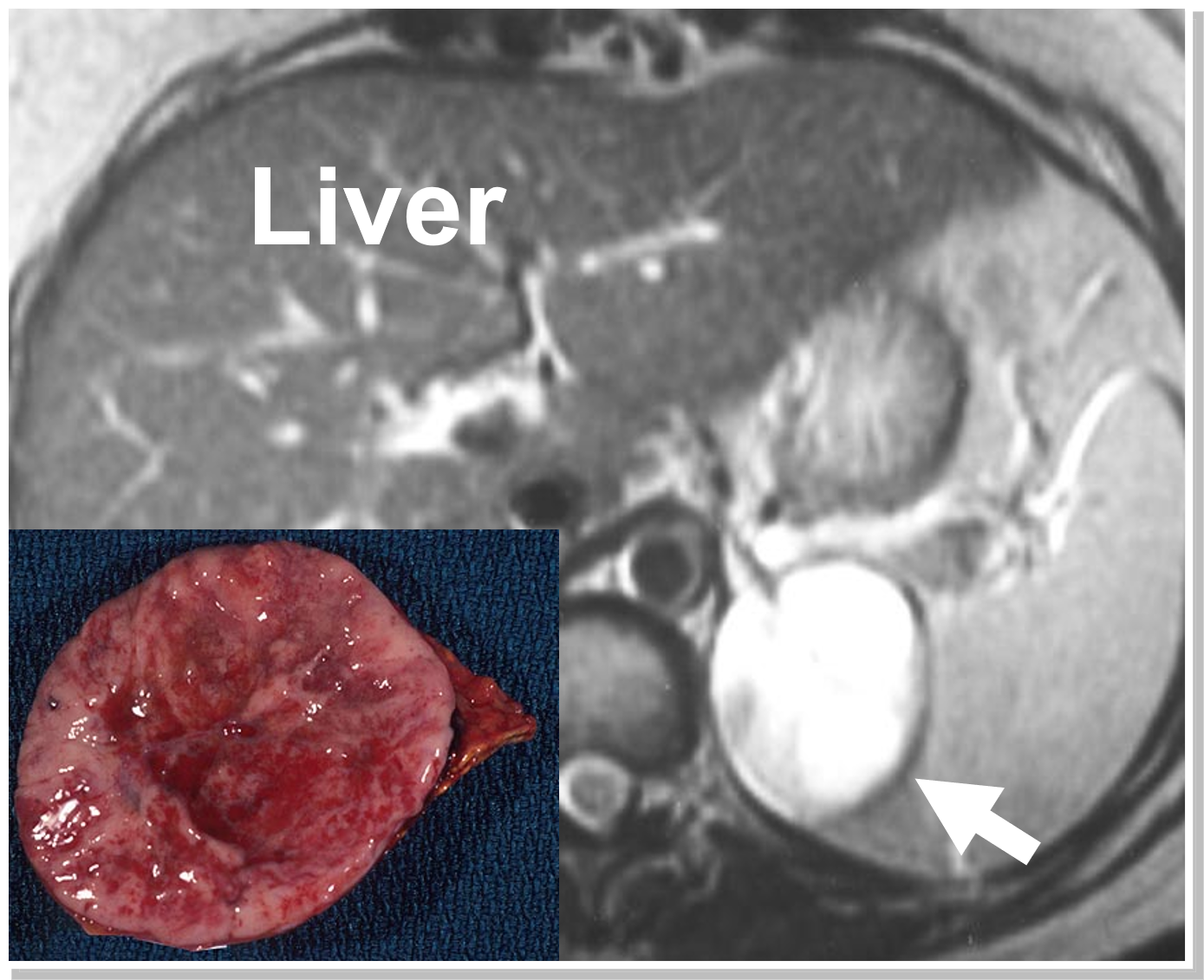 An MRI and gross pathology after removal demonstrating a left pheochromocytoma. Often pheochromocytomas enhance (light up brightly) on an MRI scan which is so characteristic that it by itself clinches the diagnosis.  