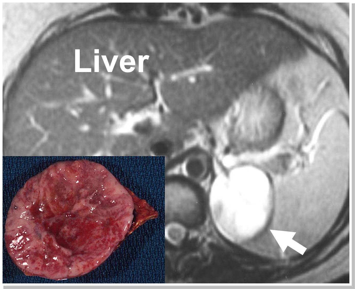 CT Scans, MRI, and Other Tests Adrenal Glands