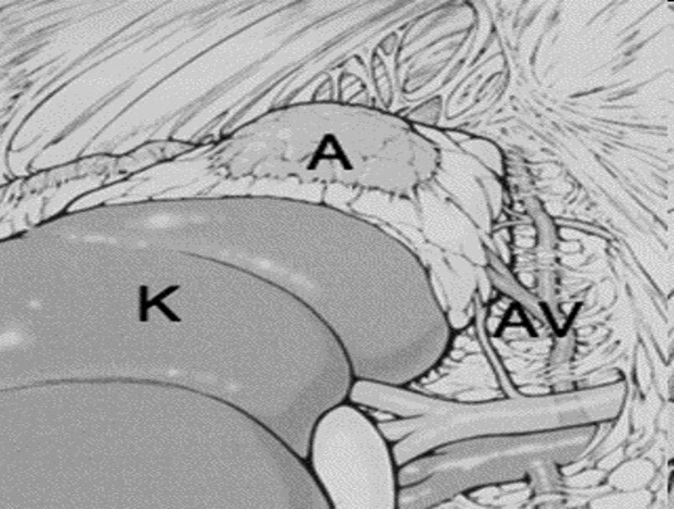 The view of the retroperitoneal space during left Mini Back Scope Adrenalectomy (MBSA). K = kidney, A = adrenal, AV = left adrenal vein and artery
