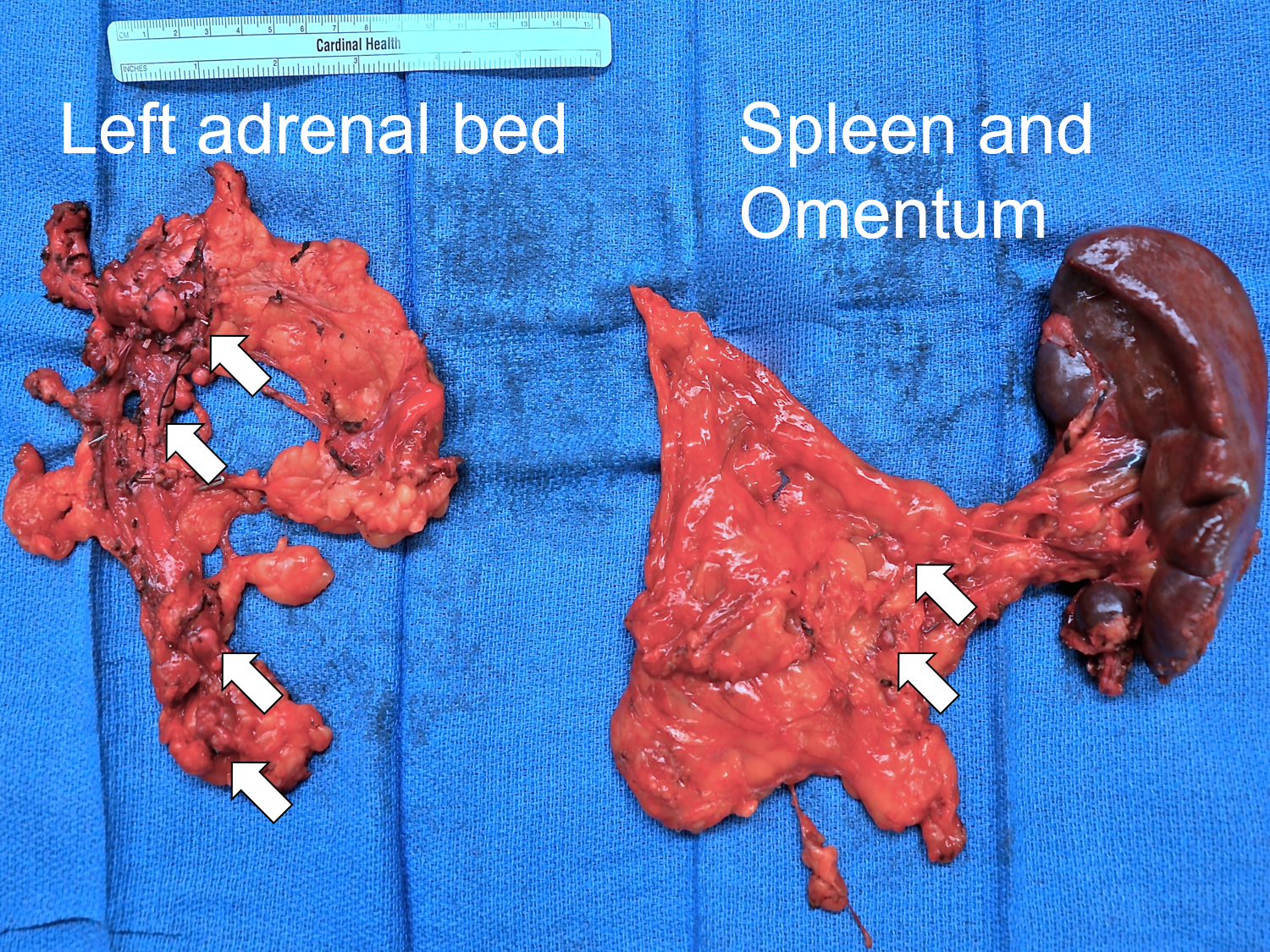 Removed tissue after an open, old-fashioned reoperation for pheochromocytoma tumor spilled throughout the abdomen (called “pheochromocytomatosis”) at the initial operation 15 years prior at an outside institution.
