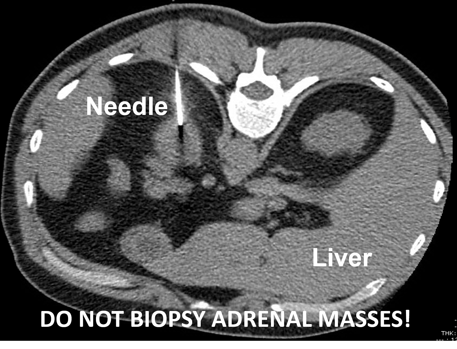 A left adrenocortical cancer undergoing a CT-guided biopsy. This should not be performed. The only time to consider a biopsy of an adrenal tumor is if the patient has another cancer and an adrenal metastasis.