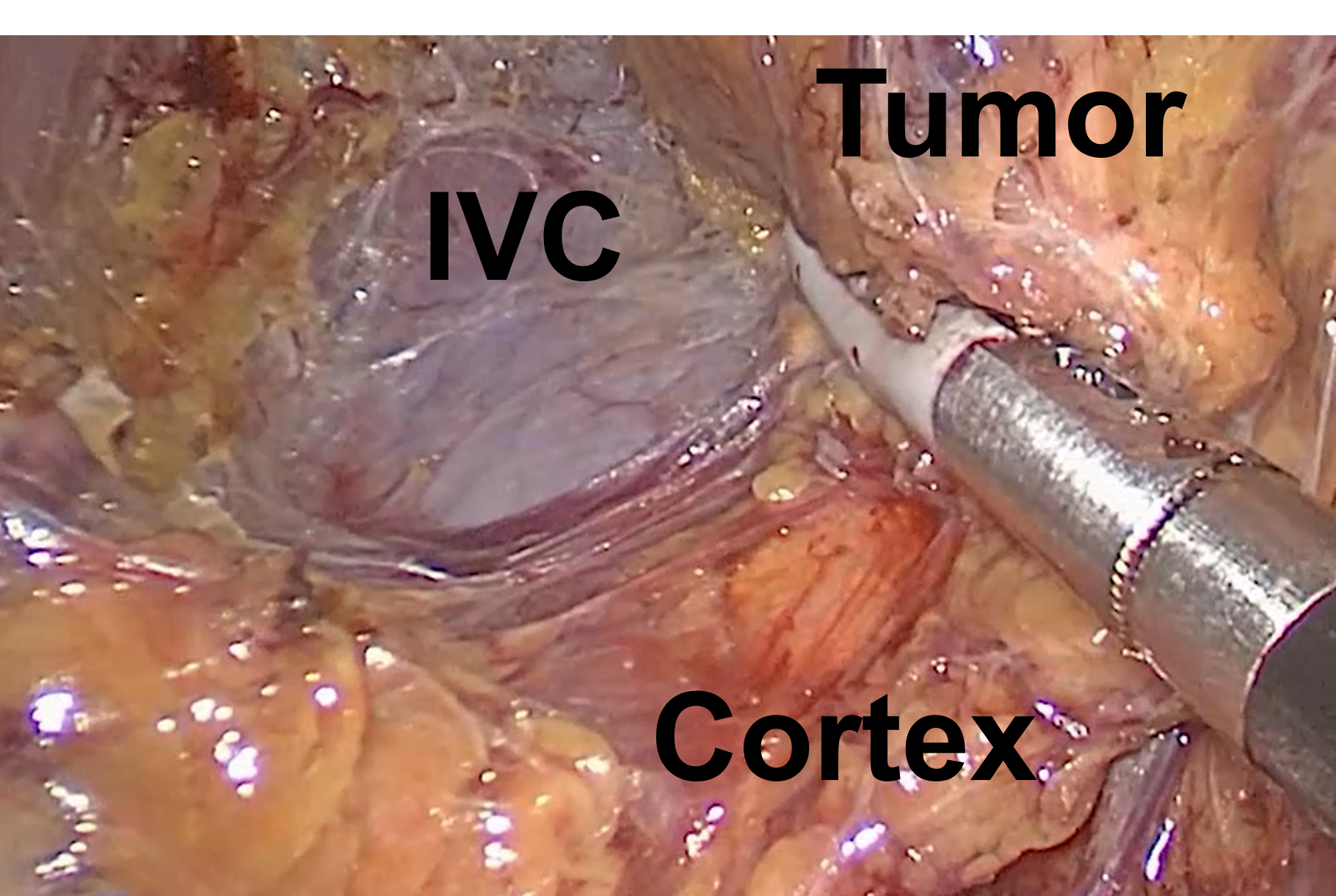 Dissection of the inferior vena cava (IVC), normal adrenal cortex, and the adrenal tumor during a right Mini Back Scope Adrenalectomy (MBSA).