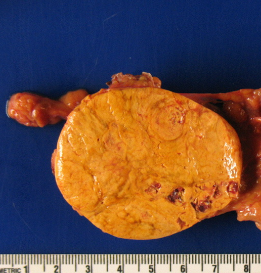Typical adrenal adenoma overproducing cortisol causing Cushing’s syndrome.