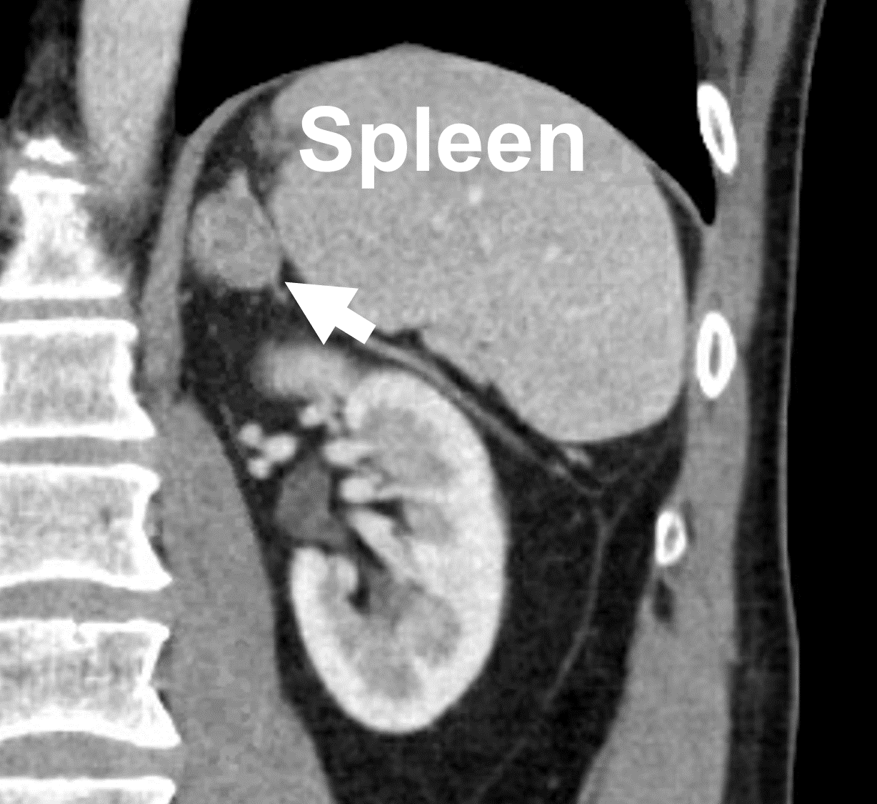 CT scan demonstrating a left adrenal metastasis from colorectal cancer (arrow). Dr. Carling performed a successful partial, cortex-sparing operation via the Mini Back Scope Adrenalectomy (MBSA) since the patients had a previous right adrenalectomy.